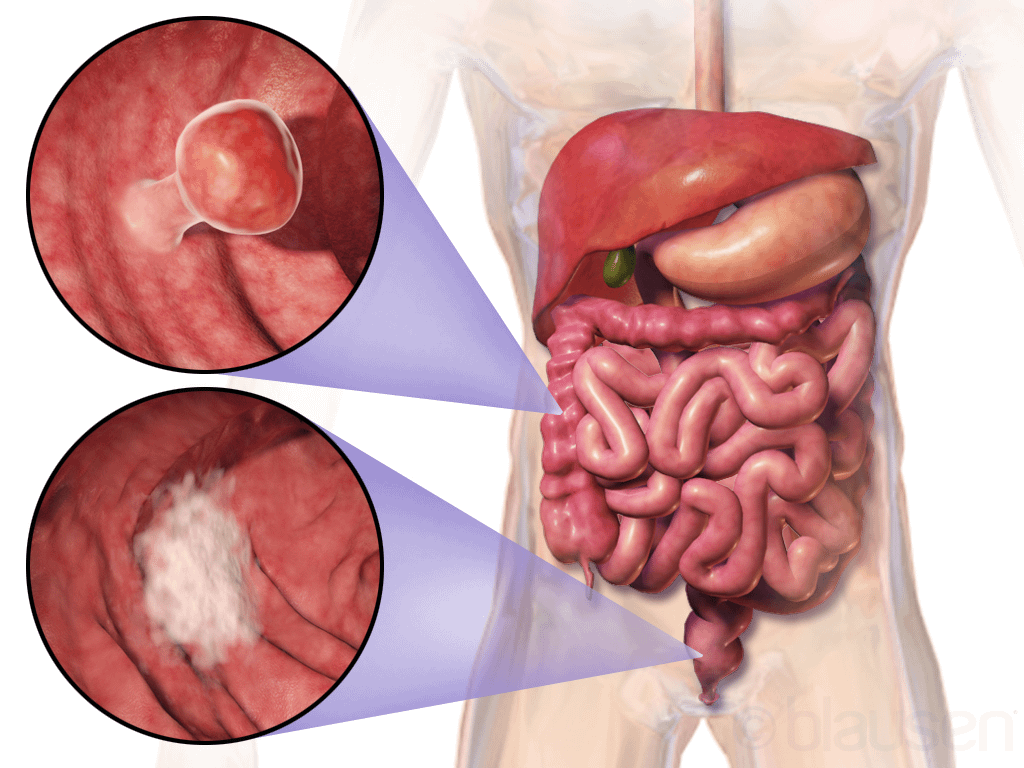 Cancer colorectal: România pe locul 1 la decese tratabile