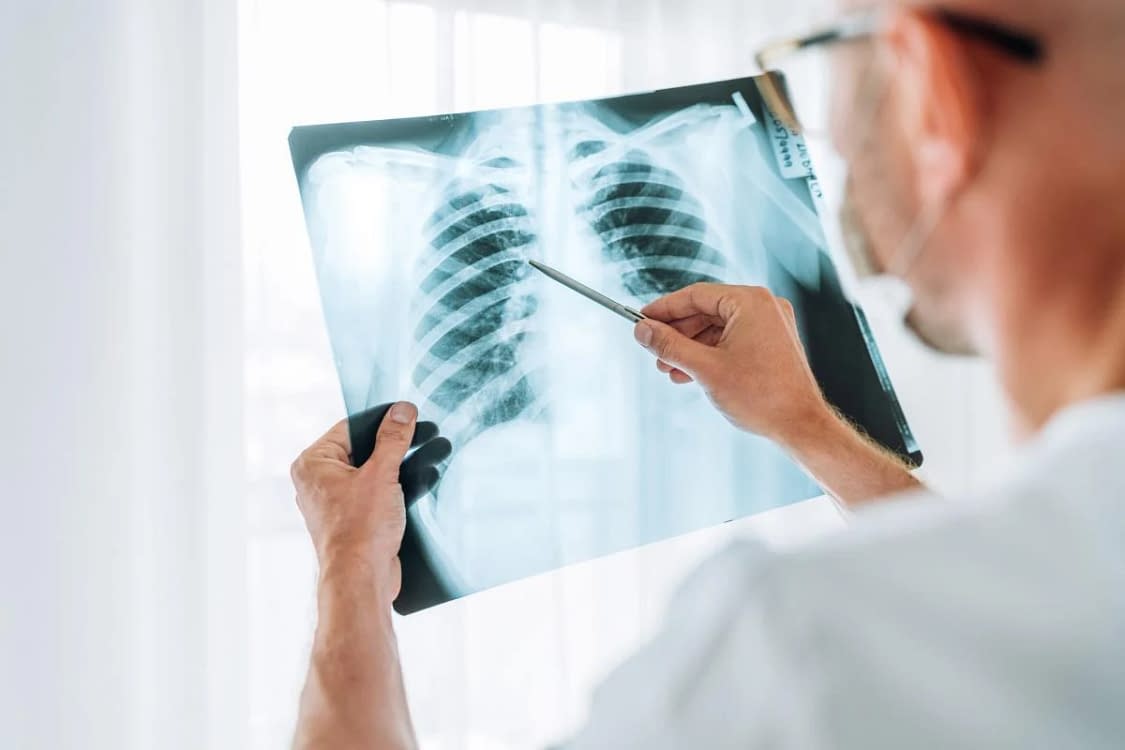 Diagnostice tot mai numeroase de cancer pulmonar în rândul nefumătorilor. Foto arhivă