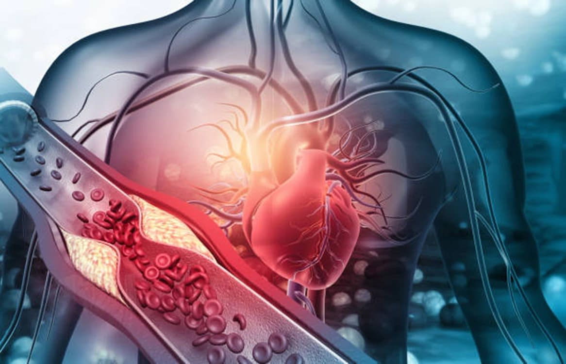 Ilustrație care arată modul în care colesterolul poate afecta inima Sursă iStock