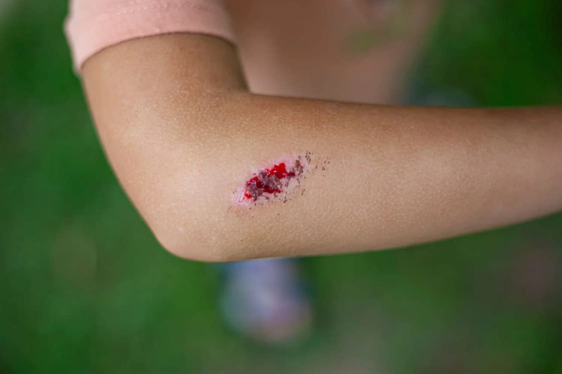 Rănile nu pot fi considerate banale când există riscul de contaminare cu spori FOTo. Shutterstock